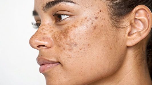 Hyperpigmentation