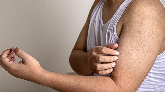 Keratosis Pilaris