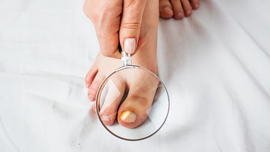 Nail Fungus