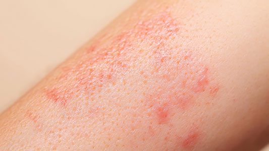 Skin Inflammation