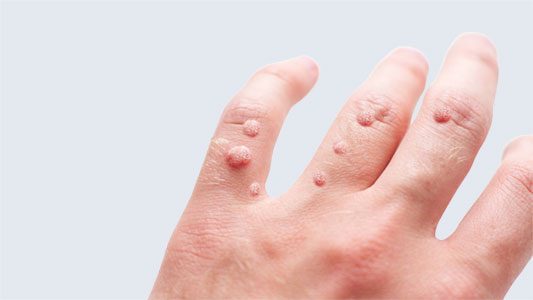 Warts